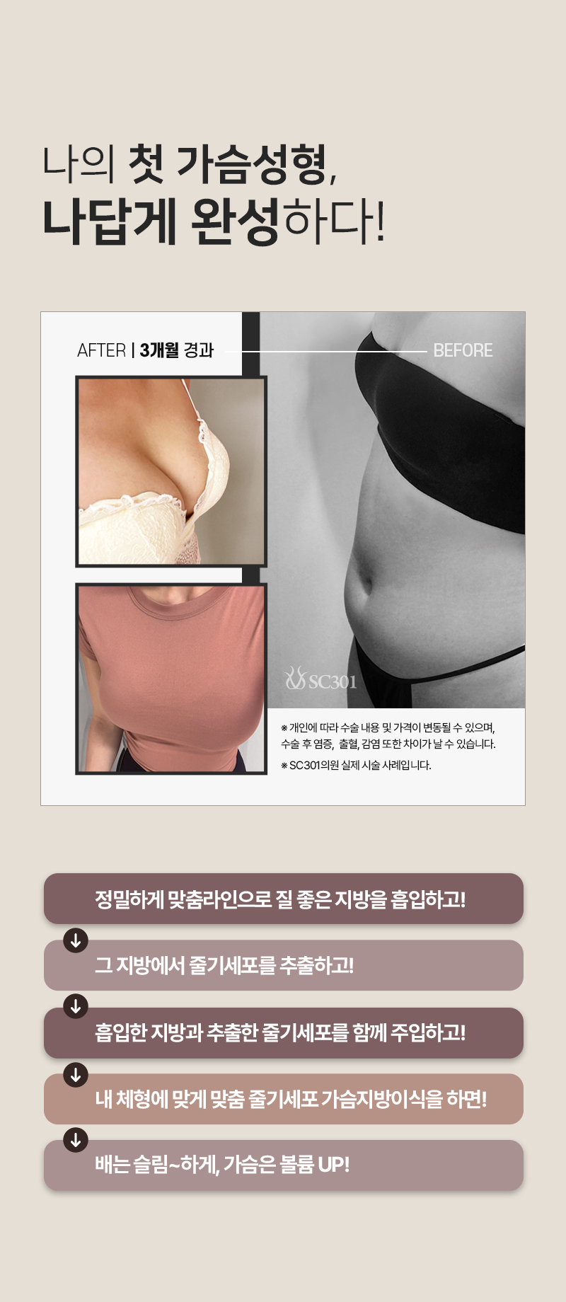 나의 첫 가슴성형, 나답게 완성하다