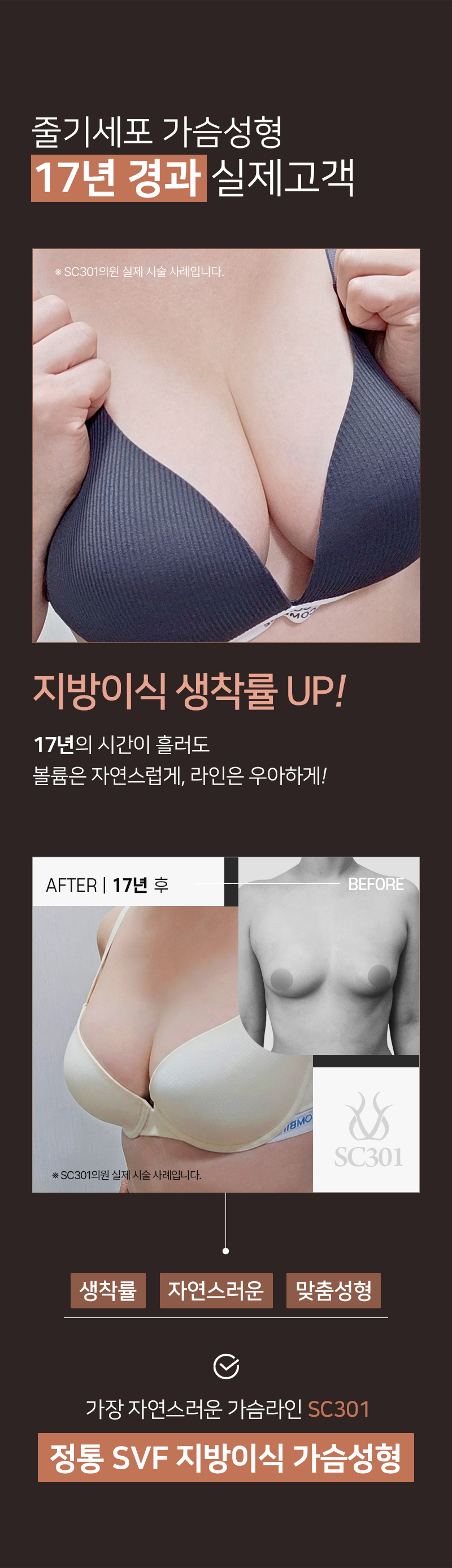 줄기세포 가슴성형 17년 경과 실제고객