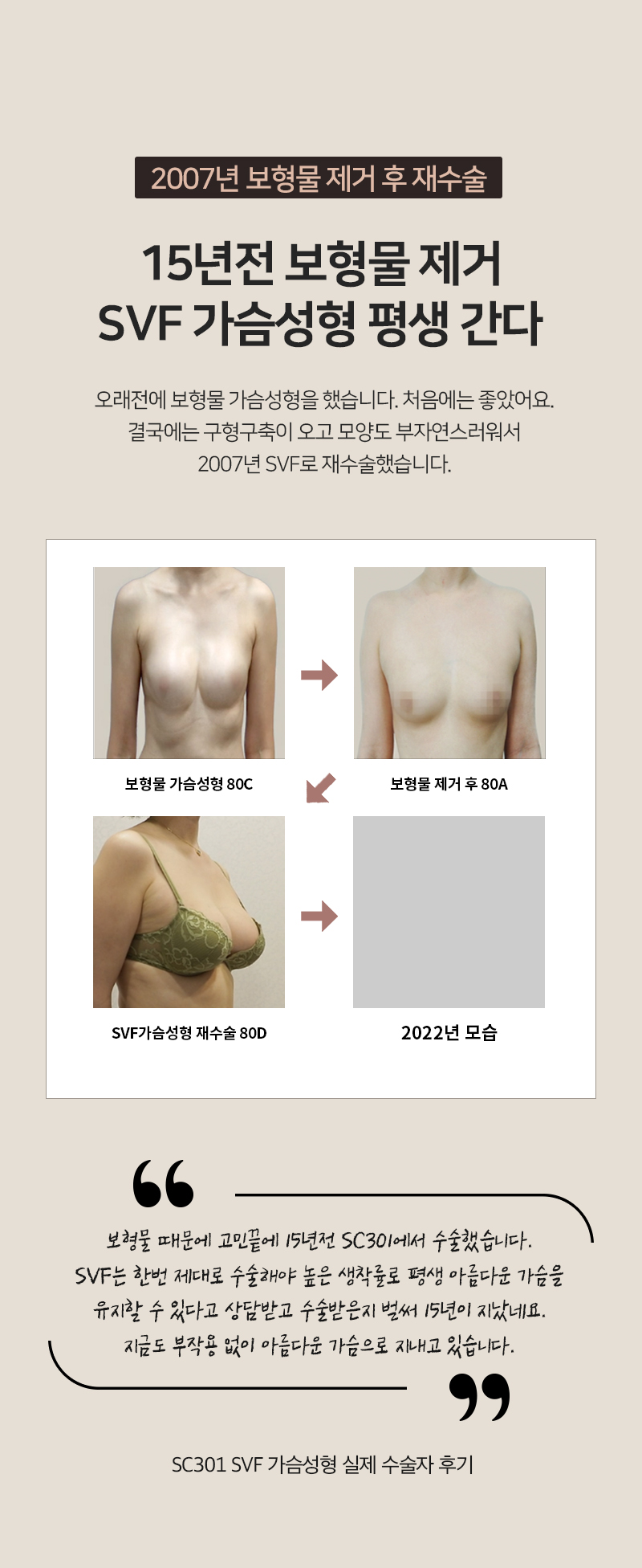 15년전 보형물 제거, SVF 가슴성형 평생 간다