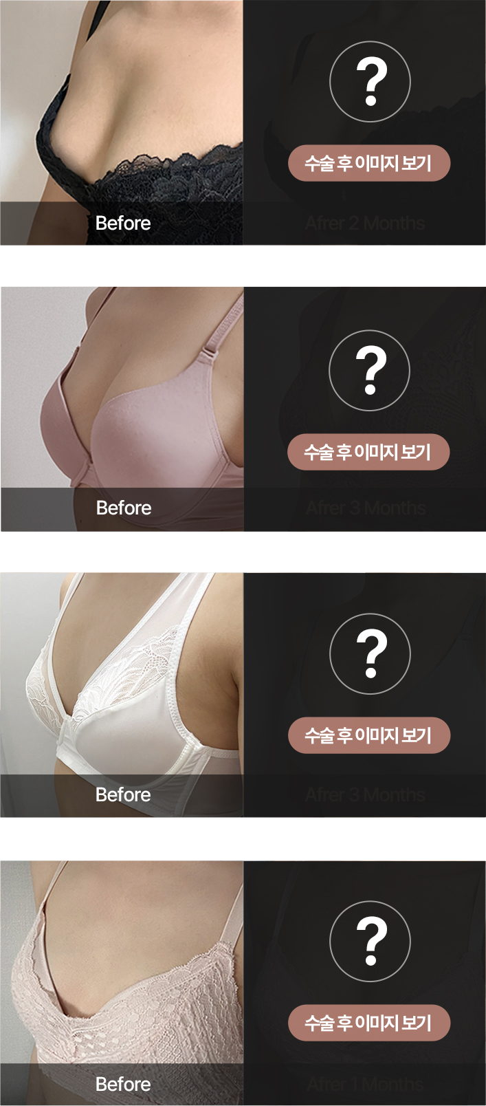 수술 후 이미지 보기 - 본인인증 후 확인 가능