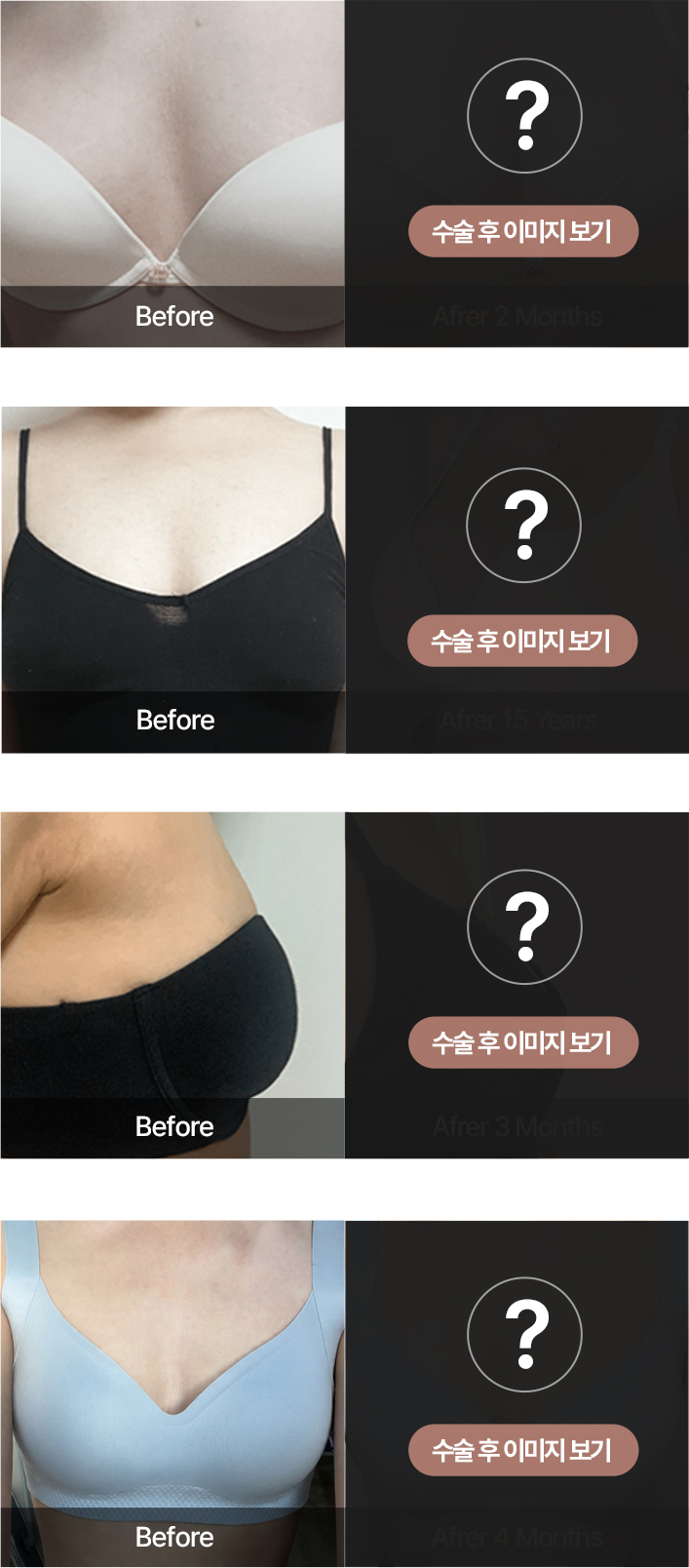 수술 후 이미지 보기 - 본인인증 후 확인 가능
